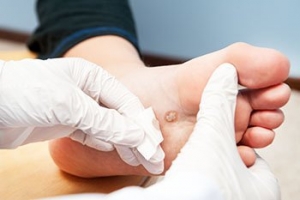 Where Is a Plantar Wart Found?