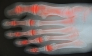 Nonsurgical Treatments for Osteoarthritis in the Feet