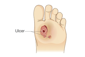 Foot Ulcers and Infections in Elderly Diabetic Patients