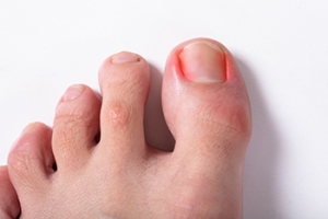 Ingrown Toenails 101
