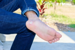 Symptoms and Treatment for Plantar Warts