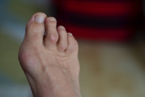 Complications of Untreated Hammertoes