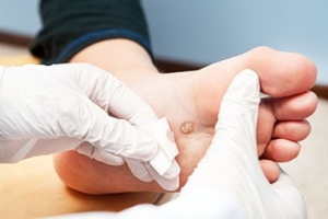 I Have a Foot Wart - Should I Be Worried?