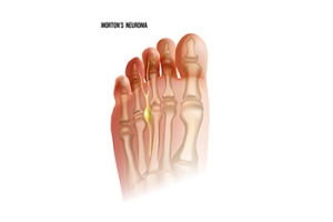 Morton&#039;s Neuroma: Causes, Symptoms, and Interventions for Relief