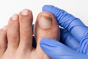 The Timeframe for Toenail Fungus to Heal