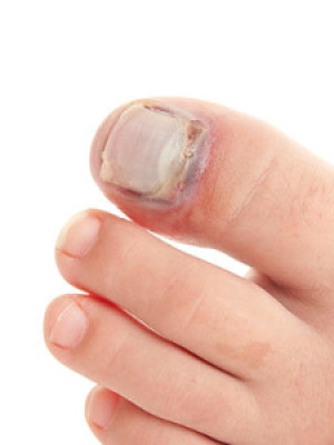 How to Treat a Broken Toe
