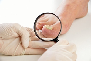 A Possible Treatment for Toenail Fungus