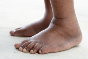 Factors and Management of Swollen Feet