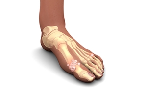 Definition and First Signs of Gout