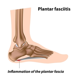Making Sense of Plantar Fasciitis